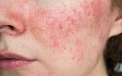 skin-irritation skin-irritation